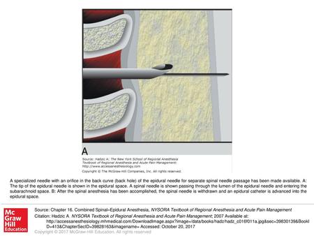 A specialized needle with an orifice in the back curve (back hole) of the epidural needle for separate spinal needle passage has been made available. A: