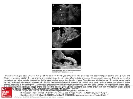 Transabdominal gray-scale ultrasound image of the pelvis in this 32-year-old patient who presented with abdominal pain, positive urine β-hCG, and history.