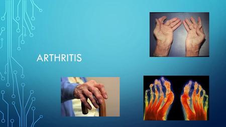 Arthritis.