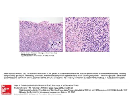 Normal gastric mucosa. (A) The epithelial component of the gastric mucosa consists of surface foveolar epithelium that is connected to the deep secretory.