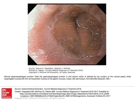 Normal gastroesophageal junction: Note the gastroesophageal junction in this picture which is defined by the junction of the normal pearly white esophageal.