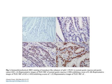 Fig. 1. Immunohistochemical (IHC) staining of transducer-like enhancer of split 1 (TLE1) in normal gastric mucosa and gastric cancer (GC). (A) Representative.