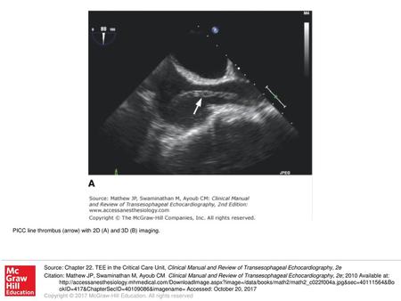 PICC line thrombus (arrow) with 2D (A) and 3D (B) imaging.