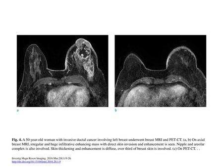 Fig. 4. A 50-year-old woman with invasive ductal cancer involving left breast underwent breast MRI and PET-CT. (a, b) On axial breast MRI, irregular and.