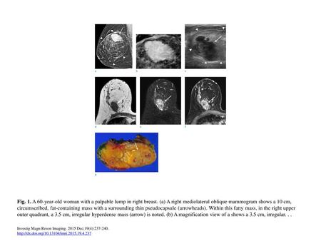 Fig. 1. A 60-year-old woman with a palpable lump in right breast