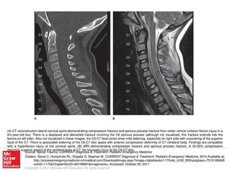 (A) CT reconstruction lateral cervical spine demonstrating compression fracture and spinous process fracture from motor vehicle collision flexion injury.