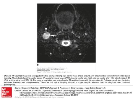 (A) Axial T1-weighted image in a young patient with a slowly enlarging right parotid mass shows a round, well-circumscribed lesion of intermediate signal.