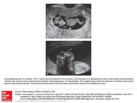 Anencephaly/acrania. A. Acrania