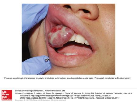 Pyogenic granuloma is characterized grossly by a lobulated red growth on a pedunculated or sessile base. (Photograph contributed by Dr. Abel Moron.) Source: