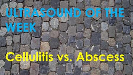 ULTRASOUND OF THE WEEK Cellulitis vs. Abscess