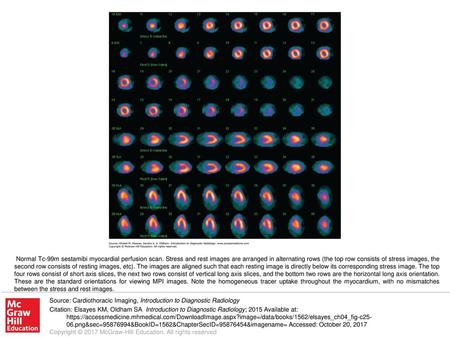 Normal Tc-99m sestamibi myocardial perfusion scan