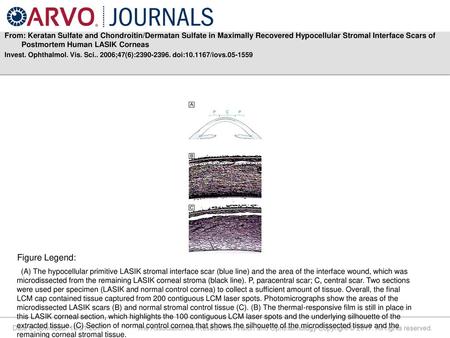 From: Keratan Sulfate and Chondroitin/Dermatan Sulfate in Maximally Recovered Hypocellular Stromal Interface Scars of Postmortem Human LASIK Corneas Invest.