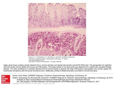 Upper panel shows a biopsy sample obtained from a normal volunteer and stained with periodic acid–Schiff (PAS) stain. The glycoprotein-rich epithelial.