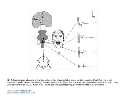 Fig. 5. Intraoperative schematic of eliciting and recording of corticobulbar motor-evoked potentials (CoMEPs). Lower left: schematic of positioning the.