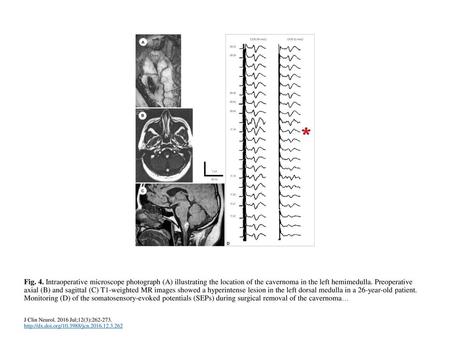 Fig. 4. Intraoperative microscope photograph (A) illustrating the location of the cavernoma in the left hemimedulla. Preoperative axial (B) and sagittal.