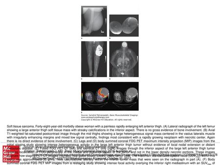 Soft tissue sarcoma. Forty-eight-year-old morbidly obese woman with a painless rapidly enlarging left anterior thigh. (A) Lateral radiograph of the left.