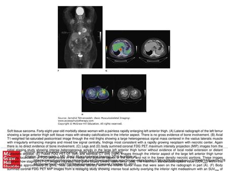 Soft tissue sarcoma. Forty-eight-year-old morbidly obese woman with a painless rapidly enlarging left anterior thigh. (A) Lateral radiograph of the left.