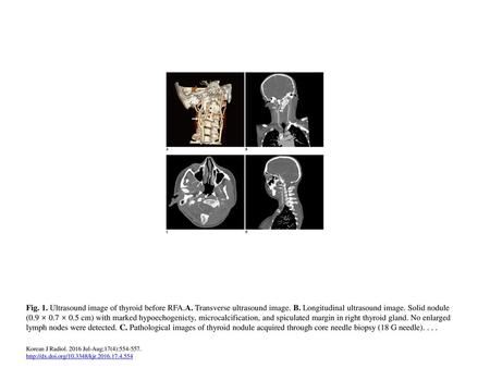 Fig. 1. Ultrasound image of thyroid before RFA. A