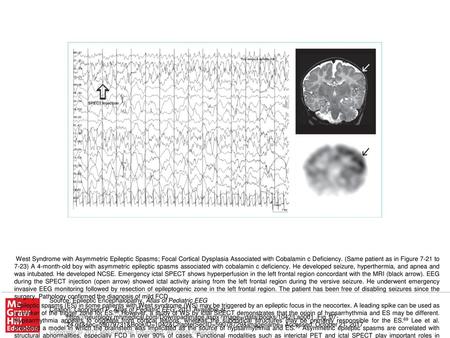 Outcomes after surgery, cortical resection, or hemispherectomy in infants with catastrophic focal epilepsy are very good. About 75–78% are seizure-free.