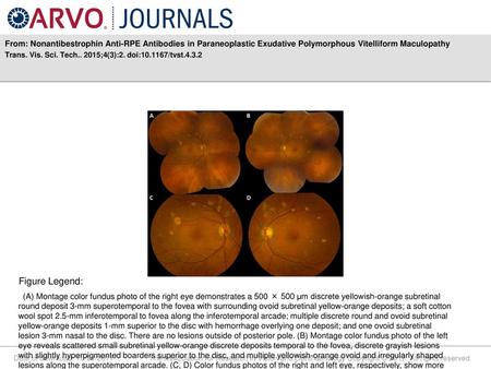 From: Nonantibestrophin Anti-RPE Antibodies in Paraneoplastic Exudative Polymorphous Vitelliform Maculopathy Trans. Vis. Sci. Tech.. 2015;4(3):2. doi:10.1167/tvst.4.3.2.