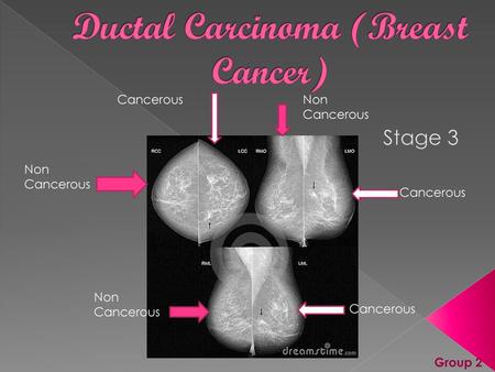 Ductal Carcinoma (Breast Cancer)