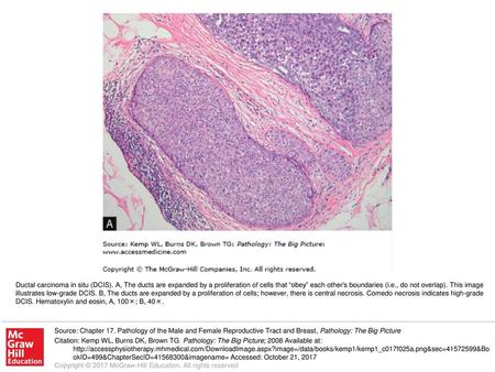 Ductal carcinoma in situ (DCIS)