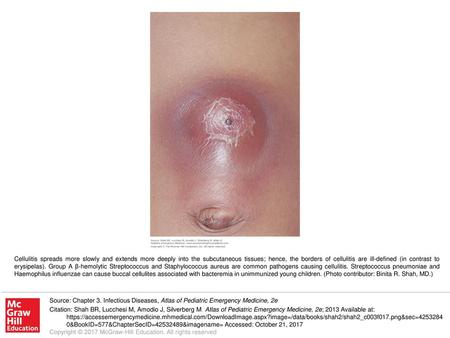 Cellulitis spreads more slowly and extends more deeply into the subcutaneous tissues; hence, the borders of cellulitis are ill-defined (in contrast to.