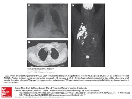 Stage IV non–small cell lung cancer (NSCLC)