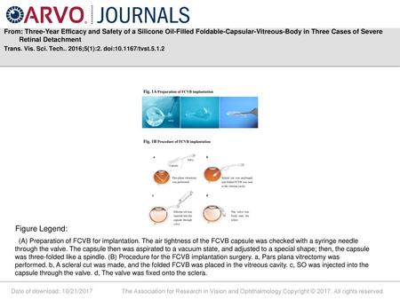 From: Three-Year Efficacy and Safety of a Silicone Oil-Filled Foldable-Capsular-Vitreous-Body in Three Cases of Severe Retinal Detachment Trans. Vis. Sci.