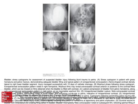 Bladder: stress cystograms for assessment of suspected bladder injury following blunt trauma to pelvis. (A) Stress cystogram in patient with gross hematuria.