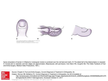 Syme amputation of toenail