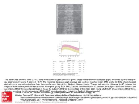 This patient has a lumbar spine (L1-L4) bone mineral density (BMD) of 0.410 g/cm2 (cross on the reference database graph) measured by dual-energy x-ray.