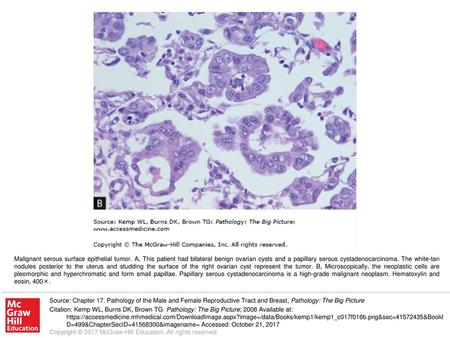 Malignant serous surface epithelial tumor