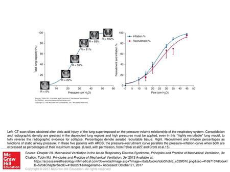 Left. CT scan slices obtained after oleic acid injury of the lung superimposed on the pressure-volume relationship of the respiratory system. Consolidation.