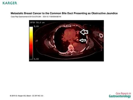 Case Rep Gastroenterol 2015;9: DOI: /