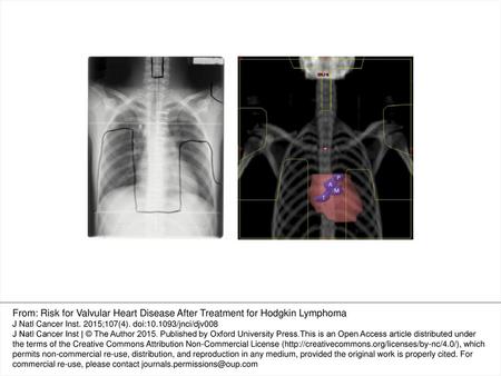 Figure 1. An example of an original simulation film used during the 1960s to 1990s to plan radiotherapy for Hodgkin lymphoma, with field borders marked.