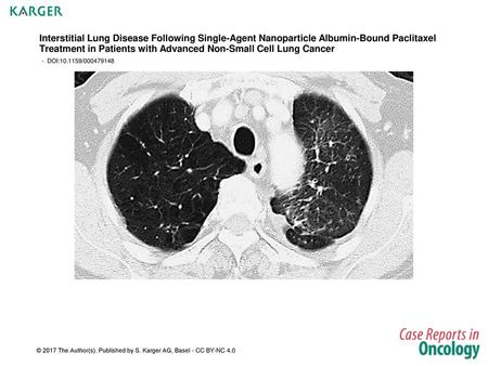 Interstitial Lung Disease Following Single-Agent Nanoparticle Albumin-Bound Paclitaxel Treatment in Patients with Advanced Non-Small Cell Lung Cancer -