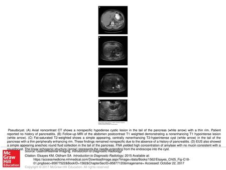 Pseudocyst. (A) Axial noncontrast CT shows a nonspecific hypodense cystic lesion in the tail of the pancreas (white arrow) with a thin rim. Patient reported.