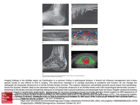 Imaging findings in the Achilles region (a) Calcification is a common finding in pathological tendons. It should not influence management and a bone spicule.