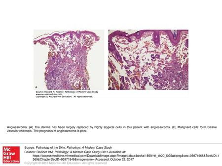 Angiosarcoma. (A) The dermis has been largely replaced by highly atypical cells in this patient with angiosarcoma. (B) Malignant cells form bizarre vascular.