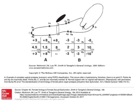 A: Example of complete vaginal prolapse (eversion) using POPQ classification. This occurs after a hysterectomy; therefore, there is no point D. Points.