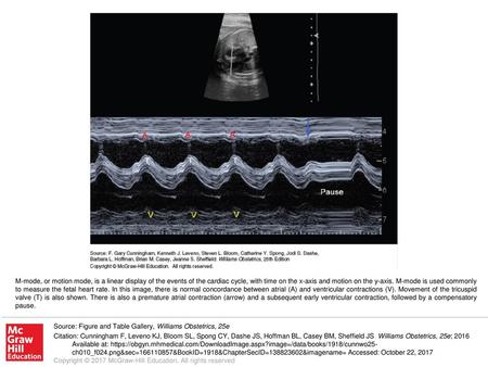 M-mode, or motion mode, is a linear display of the events of the cardiac cycle, with time on the x-axis and motion on the y-axis. M-mode is used commonly.