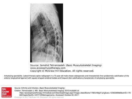 Ankylosing spondylitis