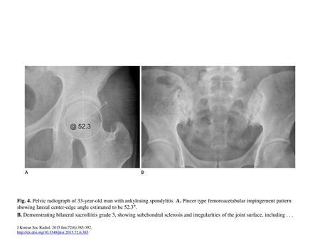 Fig. 4. Pelvic radiograph of 33-year-old man with ankylosing spondylitis. A. Pincer type femoroacetabular impingement pattern showing lateral center-edge.