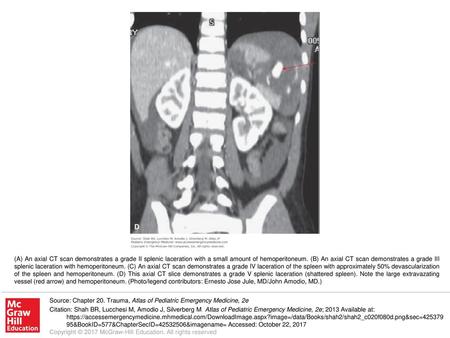 (A) An axial CT scan demonstrates a grade II splenic laceration with a small amount of hemoperitoneum. (B) An axial CT scan demonstrates a grade III splenic.