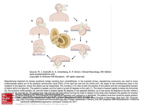 Repositioning treatment for benign positional vertigo resulting from canalolithiasis. In the example shown, repositioning maneuvers are used to move endolymphatic.