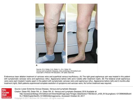 Endovenous laser ablation treatment of varicose veins and superficial venous insufficiency. (A) The right great saphenous vein was treated in this patient.