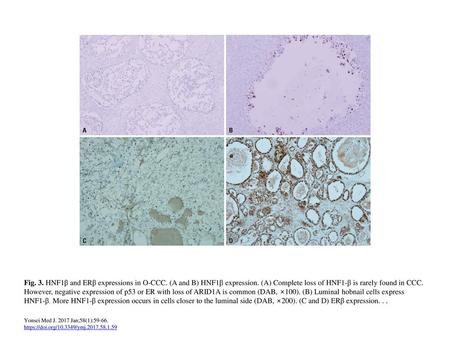 Fig. 3. HNF1β and ERβ expressions in O-CCC. (A and B) HNF1β expression