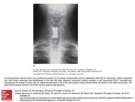 A. Anteroposterior cervical spine x-ray showing the position of an anterior cervical plate used for stabilization after C6–C7 discectomy. Patient presented.