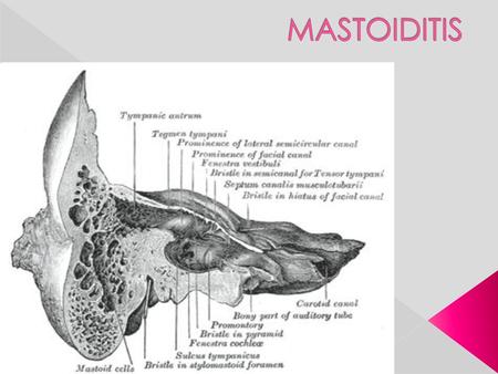 MASTOIDITIS.